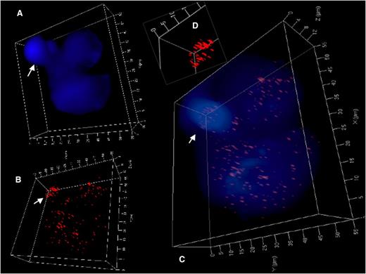 Figure 4. 3D identification of disturbed nuclear telomere organization in a trinuclear LMP1-expressing RS-like BJAB-tTA-LMP1 cell. (A) 3D reconstruction of nuclear DNA (DAPI; blue) in surface mode reveals a small folded satellite nucleus (arrow), a second nucleus at the upper right and a third large nucleus at the bottom. (B) 3D telomere (red) reconstruction in surface mode reveals abundant telomeres in lower part of the small satellite nucleus (arrow) and irregular telomere distribution in the large nucleus. (C) Combined 3D nuclear staining confirms telomere rich DNA dense satellite nucleus (arrow) and uneven telomere distribution in the large nucleus. (D) Inset (folded satellite nucleus) localizes short telomeres and also aggregates to its lower part. Further 3D telomere analysis of this satellite nucleus is shown in supplemental Figure 2B.