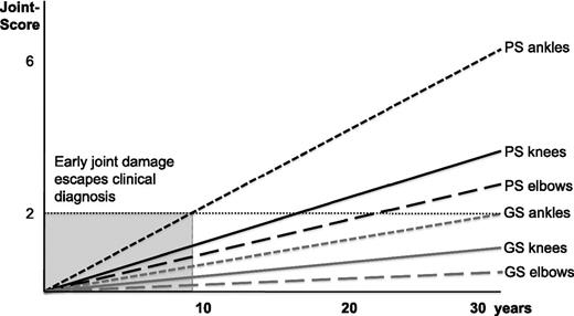 Figure 2. Illustration and schematization of the long-term outcome results. Results of the 2013 study by Krämer et al,20 underlining that progression of joint arthropathy during intensive prophylaxis regimens is a process with subtle progression over years. Scores ≥2 are regarded to be pathological. The ankle joints are the first joints that develop arthropathy after a median time of 10 years, followed by knee joints and elbow joints significantly later. The clinical Gilbert scores are following the Pettersson scores 1 to 2 decades later. The gray area indicates the initial decade of prophylactic treatment when early joint disease remains undetected by the Pettersson score. GS, Gilbert score; PS, Pettersson score.