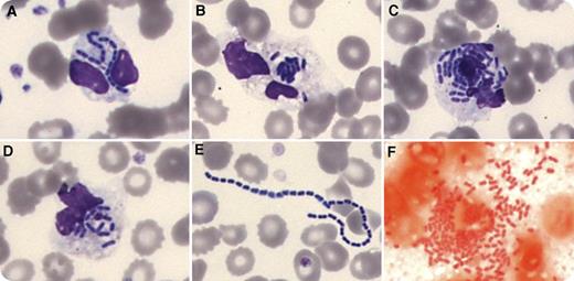A 38-year-old woman was admitted as an outpatient for arsenic trioxide consolidation for acute promyelocytic leukemia. Findings of the clinical examination were normal, except for a brief episode of fever 2 days before. The C-reactive protein level was elevated (60 mg/L). May-Grünwald-Giemsa–stained blood smear analysis showed small dark purple rods in ∼15% of the neutrophil granulocytes (panels A-D) as well as extracellular bacteria forming chains (panel E). Gram staining confirmed the presence of Gram-negative bacteria (panel F). Because of this observation, blood cultures were performed, which confirmed a diagnosis of catheter-related bacteremia due to Enterobacter aerogenes. As Gram-negative bacteria rarely form chains, we hypothesized that the bacteria initially observed on the blood smear might be an EDTA contaminant. However, the same E aerogenes grew in blood cultures from the EDTA tube, which ruled out this hypothesis. The evolution was favorable after removal of the catheter and antibiotic therapy with piperacillin-tazobactam. / In contrast to other fluids like pleural effusion or cerebrospinal fluid, the observation of bacterial phagocytosis by neutrophils on a blood smear is very unusual. In this particular case, it led to adequate bacteriologic investigation and successful treatment.