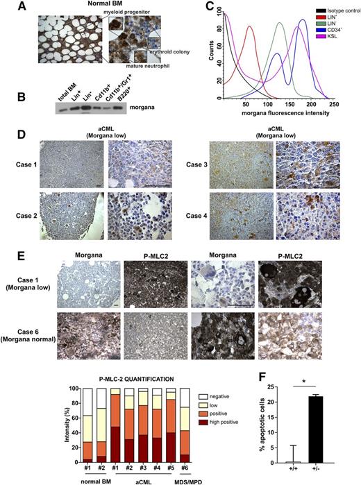 Figure 3. Morgana is underexpressed in aCML patients’ BM. (A) Morgana IHC staining on normal human BM. (B) Western blot analysis of morgana in different BM populations and in total mouse BM. (C) Morgana fluorescence intensity in different mouse BM populations as assessed by flow cytometry. (D) Morgana IHC staining on BM biopsies of 4 aCML patients. The scale bar = 100 μm. (E) P-MLC2 IHC staining on a BM biopsy from an aCML patient expressing low morgana level (case 1) and a case of MDS/MPD expressing normal morgana level (case 6). The scale bar = 100 μm. The graph shows the IHC quantification of P-MLC2. (F) Percentages of apoptosis in BM cells derived from morgana+/+ and morgana+/–-diseased mice after 48 hours of treatment with fasudil (10 μM). *P < .05.