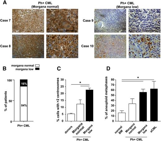Figure 4. Morgana is underexpressed in a subgroup of CML Ph+ patients. (A) Morgana IHC staining on BM biopsies of representative Morgana normal (cases 7 and 8) and Morgana low (cases 9 and 10) Ph+ CML patients. The scale bar = 100 μm. (B) The graph indicates the percentage of Ph+ CML patients expressing morgana at normal (84%) and low (16%) levels as assessed by IHC analysis on BM sections (n = 19). (C) Percentages of CD34+ BM cells with >2 centrosomes in CML patients at diagnosis, expressing normal or low morgana levels (n = 4 patients per group) and healthy donors (n = 3). The black bar indicates low morgana expression levels. (D) Percentage of aneuploid metaphases in Morgana normal and Morgana low Ph+ CML and Morgana low aCML BM cells compared with normal BM cells. The black bars indicate low morgana expression levels. *P < .05.