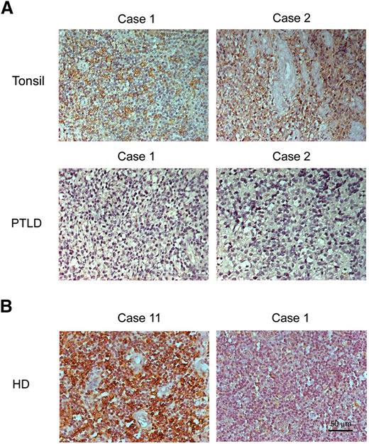 Figure 7. HLA-DR is not expressed in PTLD biopsies compared with tonsil biopsies. PTLD, tonsils, and HD sections were used for IHC assays and the nuclei counterstained with hematoxylin. (A) Positive signals of HLA-DR were observed as a brown color in tonsil biopsies but not in PTLD biopsies. (B) Positive signals of HLA-DR were observed as a brown color in EBER− biopsy (case 11) but not in EBER+ biopsy (case 1). The nuclei are stained blue. Original magnification, ×200. Scale bar indicates 50 μm.