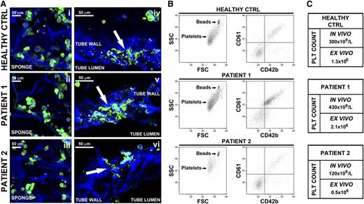 Figure 8. Analysis of ex vivo platelet release by Mks differentiated from adult human peripheral blood hematopoietic progenitors. (A) Confocal microscopy imaging of Mks from 1 healthy control and 2 patients within the silk-based bone marrow system. (Ai-Aiii) Imaging of mature Mks immediately after seeding into the silk sponge (green = CD61; blue = nuclei; scale bar = 50 μm). (Aiv-Avi) Mks forming proplatelet through the silk microtube wall (green = CD61; blue = nuclei; scale bar = 50 μm). Arrows indicate proplatelet branching and elongation. Silk fibroin 3D scaffolds were stained with Hoechst 33258 and visualized in blue. (B) Flow cytometry analysis of ex vivo-produced platelets. Samples were mixed with counting beads to quantify the number of CD61+CD42b+ platelets. (C) Comparison of platelet count between in vivo and ex vivo quantified numbers.