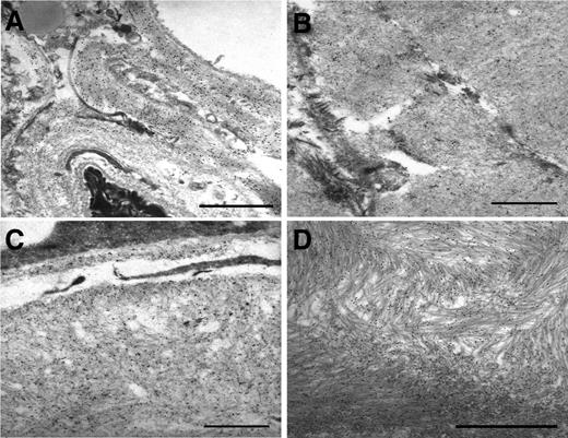 Figure 1. IEM of abdominal fat aspirates from patients with different amyloid diseases. Postembedding immunostaining with polyclonal anti-λ light chains (A), anti-k light chains (B), and monoclonal anti-SAA (C) and polyclonal anti-TTR (D) antibodies. Secondary antibodies are conjugated with gold particles 15 nm in diameter. Uranyl acetate, lead citrate. Scale bar, 1 μm.