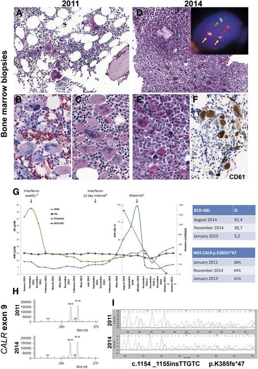 Figure 1. Morphologic and molecular findings in a case of CALR-mutated essential thrombocytemia that evolved into a CALR-mutated BCR-ABL+ chronic myeloid leukemia. (A-C) Bone marrow biopsy in 2011. (A) Normocellular BM with increased amount of large hyperlobated “staghorn” megakaryocytes (PAS stain). (B-C) Higher magnification showing the loose clusters of megakaryocytes with mainly staghorn forms (B: Giemsa stain; C: periodic acid Schiff stain). (D-F) BM biopsy in 2014. (D) Hypercellular BM with increased myeloid:erythroid ratio and increased amount of small hypolobated dwarf megakaryocytes (PAS stain). Insert: Interphase fluorescent in situ hybridization analysis using BCR-ABL dual color, dual fusion translocation probe (Zytotomed, Zytolight BCR-ABL) shows one red signal (red arrow), one green signal (green arrow), and two red/green fusion signals (yellow arrow) indicative of a t(9;22)(q34;q11). (E) Higher magnification showing the atypical small hypolobated megakaryocytes in a background of left-shifted granulopoiesis (periodic acid Schiff stain). (F) CD61 (Dako; Glostrup, Denmark) staining highlights the small hypolobated megakaryocytes. (G) Graphic depiction of the peripheral blood counts from January 2011 to January 2015. The patient was treated originally with interferon 135 µg. In October 2014, he was switched to nilotinib 150 mg (2-0-2). The top table shows the quantitative reverse transcription polymerase chain reaction (qRT-PCR) results of the BCR-ABL fusion transcript in international standard (IS). The bottom table shows the next-generation sequencing results of the allele burden of CALR mutant. (H) Fragment length analysis of CALR exon 9 hotspot region shows concurrent amplification of the wild-type allele resulting in a 257-bp fragment and a mutated allele of 262 bp in both BM biopsies. (I) Sanger sequencing of the CALR exon 9 hotspot region confirmed an identical frameshift mutation in both biopsies (c.1154_1155insTTGTC, p.K385fs*47). Fluorescent in situ hybridization images were acquired with a ×100/1.40 oil immersion objective in a Zeiss Axio fluorescence microscope (Zeiss) equipped with the appropriate filters sets and an Axio CAM MRm camera (Zeiss) and were documented and processed by using the Axio Vision Rel 4.8 software (Zeiss). Immunohistochemical analysis was performed on an automated immunostainer (Ventana Medical Systems, Tucson, AZ), following the manufacturer's protocols. Fragment analysis of CALR exon 9 hotspot region was performed by using Phusion Hot Start DNA polymerase (Finnzymes) with adequate amplification conditions and D4-fluorescent dye primer modification (Sigma-Aldrich).2 The products were separated by capillary electrophoresis on the GenomeLab GeXP Genetic Analysis System and analyzed with GenomeLab GeXP 10.2 software (Beckman Coulter, Krefeld, Germany). Sequencing of CALR exon 9 hotspot region was performed by using M13-tailed primers (forward: 5′-CTGGTCCTGGTCCTGATGTC-3′; reverse: 5′-GGGGACATCTTCCTCCTCAT-3′) and Phusion Hot Start DNA polymerase with adequate amplification conditions, followed by dye terminator cycle sequencing (Quick Start Master Mix) using M13 primers and capillary electrophoresis on the GenomeLab GeXP Genetic Analysis System 10.2 software. Next-generation sequencing was applied for mutational screening of CALR (exon 9). By using a 2-step PCR, design amplicons were generated that included sequencing adaptors for Roche 454 sequencing and an individual multiplex identifier (MID tag) to allow multiplexing. After amplicon pooling, the library was purified (QIAquick PCR purification kit; Qiagen, Hilden, Germany) followed by agencourt AMPure XP (Beckman Coulter) and quantified by using the Quant-iT PicoGreen Kit (Invitrogen, Carlsbad, CA). Following the emulsion-based PCR amplification (GS Junior emPCR kit), clonally amplified beads were enriched according to the manufacturer’s recommendations and quantified on a CASY cell counter (Roche). The 454 sequencing data were generated on a GS Junior using the GS Junior Titanium Sequencing Kit (Roche). The expected coverage was ×1000. Data analysis was performed by using JSI Sequence Pilot, SEQNext (JSI Medical Systems GmbH, Kippenheim, Germany). Hb, hemoglobin.