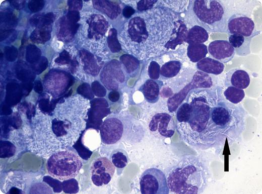 A 72-year-old woman presented with a 1-month history of weakness. Medical history included a smoldering myeloma diagnosed 2 years before, an autoimmune pancytopenia treated with prednisone for the past year, and an episode of pulmonary nocardiosis successfully treated with co-trimoxazole 6 months before. Notably, the bronchoalveolar lavage that helped diagnose the nocardiosis also revealed Mycobacterium avium that was considered an innocent bystander. On admission, the patient suffered from pancytopenia (hemoglobin, 112 g/L; leukocytes, 2.0 × 109/L; platelets, 33 × 109/L; neutrophils, 1.29 × 109/L) with 6 CD4+ T cells/mm3. May-Grünwald-Giemsa coloration of the bone marrow aspirate showed an infiltration with numerous pseudo-Gaucher cells containing cell debris and rod-like elements that did not absorb the colorant (arrow). Periodic acid–Schiff staining confirmed that they were mycobacteria (not shown). The patient was started on antimycobacterial antibiotics, but discontinued therapy and died shortly after. / Pseudo-Gaucher cells consist of macrophages whose cytoplasm has a “watered silk” appearance as they are loaded with cellular debris. Pseudo-Gaucher cells have sometimes been described in mycobacterium- and HIV-infected patients. In this case, the patient had a low CD4+ count due to immune pancytopenia and long-term steroid therapy that allowed the atypical mycobacterial infection to develop.