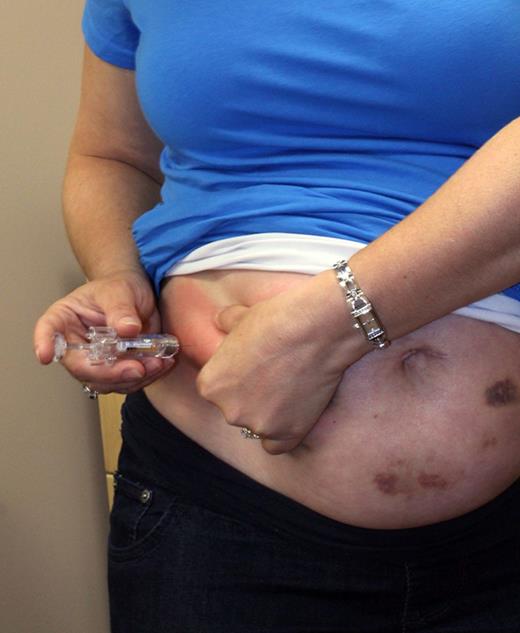 Pregnant woman self-injecting LMWH.