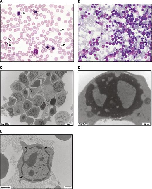 Figure 1. A case of atypical congenital dyserythropoietic anemia (CDA). (A) May-Grünwald-Giemsa (MGG)-stained blood film of patient at 4 years of age after blood transfusion. N, nucleated red blood cell; P, poikilocyte; F, fragmented cell; T, target cell; S, spherocyte. No pretransfusion film was available. (B) MGG-stained marrow biopsy at 1 week of age. More than 90% of the cells are erythroid. There are a few multinucleated cells that are characteristic of certain forms of CDA. (C-E) Electron microscopy of bone marrow. (C) Low-power view of a cluster of erythroid cells. The cell membranes are ruffled and there is some degree of dyserythropoiesis, but hyperploidy is not marked. (D) An erythroblast with a “Swiss cheese” pattern of nuclear chromatin. (E) An erythroblast with prominent gaps in the nuclear membrane.