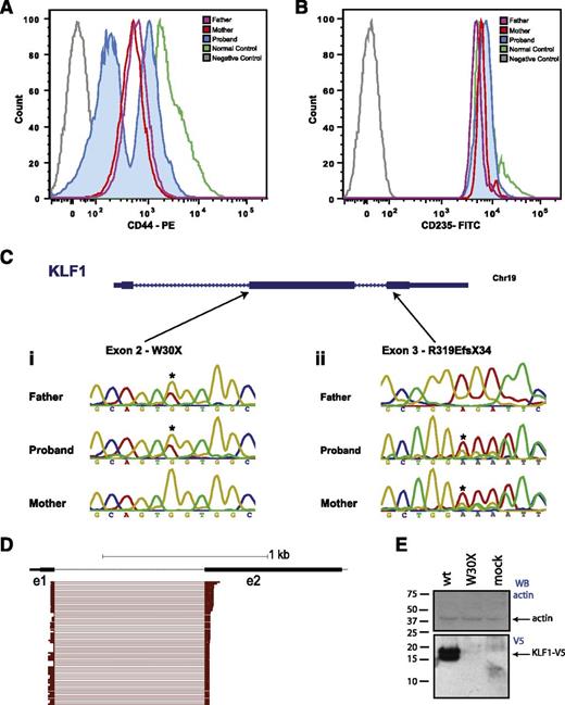 Figure 2. Inherited compound heterozygous mutations in KLF1. (A) FACS histogram overlay for CD44 expression on red blood cells for the mother, father, and proband compared with an isotype (negative) and a normal (positive) control. There is reduced expression of CD44 in both parents and 2 populations of CD44 red blood cells in the proband: CD44 high and CD44 absent. The CD44 high cells are transfused. (B) FACS histogram for CD235 (GPA) expression. There are no differences in CD235 surface expression among the normal control, the parents, and the proband. (C) Sanger sequencing traces for the parents and proband for the 2 KLF1 gene positions indicated: (i) at the start of exon 2, and (ii) the middle of exon 3. Asterisks indicate sequence variations that lead to W30X or R319EfX34 coding changes. (D) Subsampling of RNA-seq reads from the proband, filtered for those with a mapq score of ≥20 and map location to >1 exon. From a total of >100 e1-e2 splice junction tags, there were no examples of alternative mutation-skipping splice junctions. (E) Western blot of COS7 cells transfected with expression vectors for wild-type and W30X mutant KLF1 cDNA fused to a V5 tag. The bottom (anti-V5) blot shows robust expression of 2 KLF1-V5 bands in the wild-type transduced cells and no protein in the W30X-mutant transduced cells. Lane 3 is a mock-transfected control. The top panel is an antiactin blot to confirm equal protein loading.