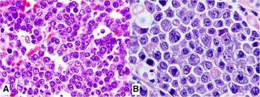 Figure 2. Histopathologic features of PBL. (A) This high magnification shows the cytologic features of a case of PBL in an HIV-positive patient. It displays large cells with an immunoblastic appearance, with central oval nuclei with prominent nucleoli and moderately abundant cytoplasm. (B) Cytologic features of a case of PBL in an HIV-negative patient with extranodal involvement away from the oral mucosa show plasmacytic plasmablasts with abundant bluish cytoplasm, paranuclear hof, and large nuclei. Hematoxylin and eosin stain; magnification, ×1000).