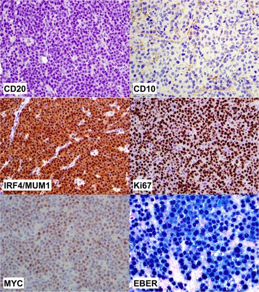 Figure 3. Immunophenotype of PBL. Immunohistochemistry with hematoxylin counterstain shows lack of expression of CD20 and CD10 and positive expression of IRF4/MUM1, Ki67, and MYC (magnification, ×400). Detection of EBER by in situ hybridization shows that neoplastic cells are positive; nuclear reactivity (×400).