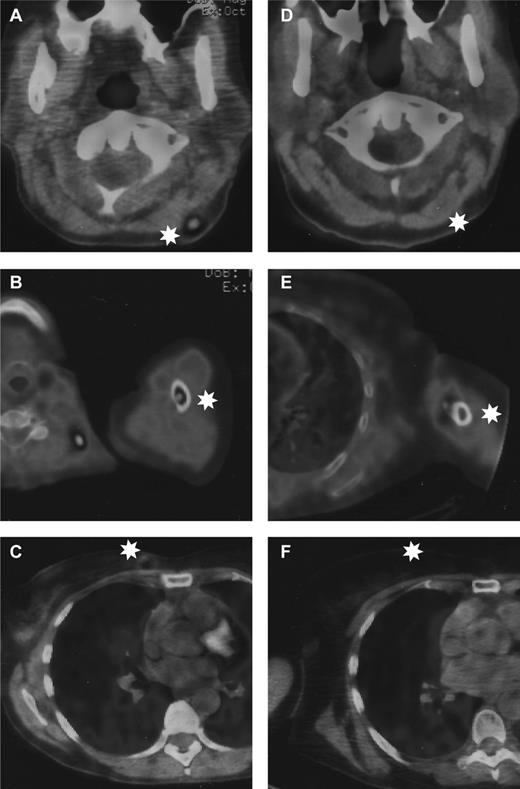 Figure 1. Representative pictures from the positron emission tomography scanner before and after interferon-free anti-HCV treatment. Left panels: photos before antiviral treatment of (A) infiltrated cervical lymph node, (B) left humeral shaft lesion, and (C) right breast lesion. Right panels: photos after sustained virologic response of (D) same cervical area, (E) left humeral shaft, and (F) right breast. White stars indicate the localization of the lymphoma.