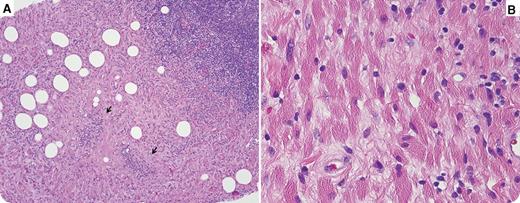 A 62-year-old woman was found to have a breast mass on screening mammography. A core biopsy was performed and revealed heterogeneous aggregates of lymphocytes and plasma cells juxtaposed against sheets of histiocytes with punctate areas of necrosis mimicking necrotizing granulomatous inflammation (panel A; arrows denote necrosis). Histiocytes had brightly eosinophilic cytoplasm engorged with crystals (panel B). The neoplastic lymphoplasmacytic cells were positive for CD20, with λ-restriction and immunoglobulin M expression. The latter was also identified in the cytoplasm of CD163-positive crystal-storing histiocytes. A diagnosis of extranodal marginal zone lymphoma (MZL) with crystal-storing histiocytosis (CSH) was rendered. Staging workup showed bilateral axillary lymph nodes that, along with the left breast mass, were mildly fluorodeoxyglucose-avid by positron emission tomography. / CSH is a rare disorder characterized by accumulation of immunoglobulin light chains within the cytoplasm of histiocytes, most commonly observed in association with underlying lymphoproliferative disorders. The majority of cases involve the head and neck region, followed by the lung. Lymphoma comprises 0.13% of all breast malignancies, with MZL constituting <10% of primary breast lymphomas and CSH of the breast being exceedingly rare, with only 4 cases reported previously in the literature. This case brings to light the unusual presentation of primary breast MZL with associated CSH.