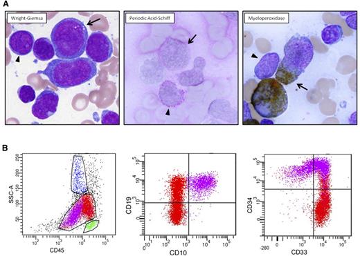 Figure 1. Diagnostic pathology of clinical case. (A) Two atypical blast populations are seen on bone marrow aspirate smear. One population (arrowhead) is composed of small cells with round nuclei, slightly condensed chromatin, distinct nucleoli, and scant cytoplasm that shows cytoplasmic reactivity with periodic acid-Schiff (PAS) in a blocklike pattern and lacks reactivity with myeloperoxidase (MPO). The other population (arrow) is composed of large cells with irregular nuclei, dispersed chromatin, variably distinct nucleoli, and small-to-moderate amounts of blue-gray cytoplasm that shows cytoplasmic reactivity with MPO and lacks reactivity with PAS. (B) Flow cytometric analysis of this bone marrow aspirate reveals 2 atypical blast populations (one highlighted in purple, one highlighted in red) with distinct CD45 expression and variable antigen expression profiles. The CD45(dim) purple population exhibits uniform expression of B-lymphoid markers CD19 and CD10, uniform stem-cell marker CD34, and variable myeloid marker CD33. The red population shows brighter CD45 expression, exhibits uniform expression of CD33, small subset CD34, variable CD19, and lacking CD10 expression.