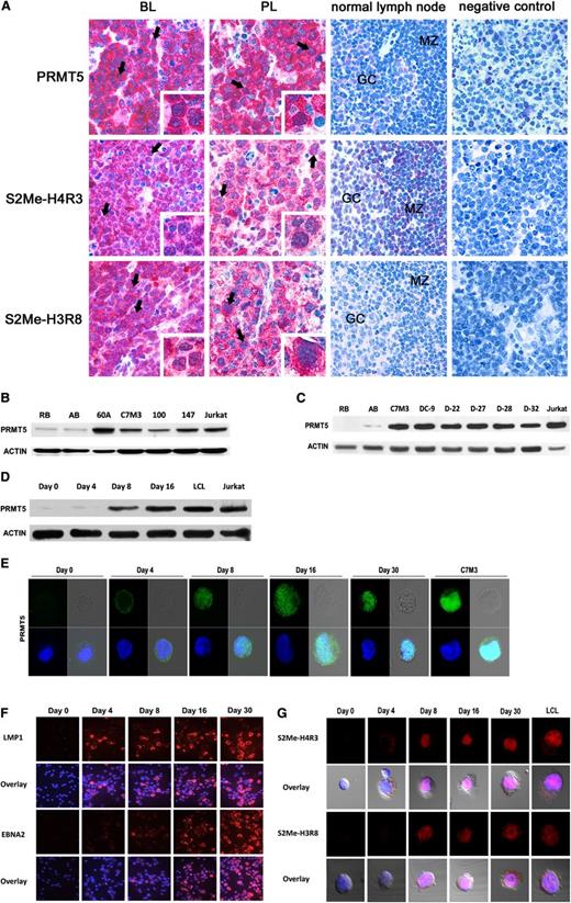 Figure 1. PRMT5 is overexpressed in EBV+ primary lymphomas, EBV-transformed and EBV-immortalized B cells. (A) Immunohistochemical nuclear/cytoplasmic expression of both PRMT5 and its epigenetic marks, S2Me-H3R8 and S2Me-H4R3, in Burkitt lymphoma (BL) (left column: ×400) and plasmablastic lymphoma (PL) (second column, from left; ×400); examples of nuclear dark red positivity are highlighted by black arrows and in the insets. The pattern of PRMT5, S2Me-H3R8, and S2Me-H4R3 expression in germinal centers (GCs) and mantle zone (MZ) of reactive lymph nodes is illustrated (third column, from left: ×400). Images of negative controls are shown (×400). (B) Western blot of PRMT5 expression in resting (RB), activated B cells (AB), and transformed LCLs obtained from hu-PBL-SCID mouse lymphomas generated from 4 separate donors (60A, C7M3, 100, 147). (C) Western blot of PRMT5 expression in RB, AB cells, and fully immortalized LCLs generated by infecting with EBV normal B cells from 6 separate healthy donors (C7M3, D-9, D-22, D-27, D-28, D-32). (D) Western blot of PRMT5 expression at various time points following in vitro infection of normal B cells with EBV. LCL is a fully immortalized cell line; Jurkat was used as positive control. Actin used as loading control. (E-G) Confocal microscopy of PRMT5 (E), LMP1 and EBNA2 (F), and PRMT5 epigenetic marks, S2Me-H4R3 and S2Me-H3R8 (G), at various time points following in vitro EBV infection of normal B cells. LCL is a fully immortalized cell line (G); C7M3 is a fully transformed cell line used as positive control (E).