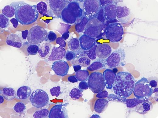 A 66-year-old woman with a history of obesity status post–gastric bypass presented with pancytopenia and no evidence of myeloneuropathy. A bone marrow biopsy was performed to exclude myelodysplastic syndrome (MDS) and showed no excess blasts and several vacuolated granulocytic (red arrow) and erythroid (yellow arrows) precursors with occasional megaloblastic change. Folate and vitamin B12 levels were normal. Iron studies showed a decreased serum iron and transferrin saturation with normal ferritin (the patient has concomitant chronic inflammation with liver disease). The aspirate also showed absent iron stores, which further confirmed iron deficiency. Cytogenetics showed a normal karyotype. Follow-up copper and ceruloplasmin levels were markedly decreased, thus consistent with a concurrent copper deficiency. Treatment with copper gluconate ultimately resolved the cytopenias. / With the rising obesity epidemic and number of gastric bypass procedures, patients presenting with cytopenias must be considered for acquired copper deficiency. Copper deficiency classically presents with cytoplasmic vacuoles in the granulocytic and erythroid precursors, iron-containing plasma cells, and ring sideroblasts (which were absent here due to iron deficiency). Megaloblastic changes in erythroids have been reported in copper deficiency. Overall, because copper deficiency may mimic MDS, it should always be ruled out to avoid misguided treatment.