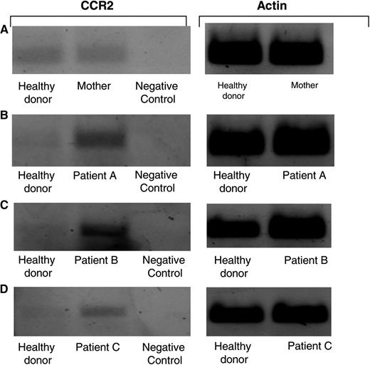 Figure 5. Increased mRNA levels of CCR2 receptor in TAP-2–deficient CANK cells. Semiquantative RT-PCR analysis for CCR2 mRNA levels was performed on various cDNA libraries obtained. Healthy donor–derived cDNA was prepared from an mRNA pool purified from equal numbers of CANK cells from 7 healthy persons. cDNA obtained from 1106 melanoma cell line was used as a negative control for CCR2 receptor. RT-PCR analysis was performed to compare intensities of CCR2 levels on CANK cell lines between healthy donors and (A) the mother of patients A, B, and C with TAP-2 deficiency, (B) patient A, (C) patient B, and (D) patient C. Results are from 1 independent experiment of 4 experiments performed.