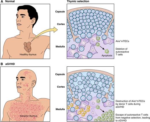 Alloreactive donor T cells destroy Aire+mTECs during aGVHD, allowing escape of autoreactive T cells that contribute to cGVHD. (A) In healthy individuals, mTECs (purple) mediate negative selection of thymocytes (blue) to eliminate autoreactive T cells (green) recognizing self-peptides presented on MHC molecules. (B) During aGVHD, alloreactive donor T cells (yellow) damage the thymus and eliminate mTECs, allowing escape of autoreactive T cells (green) that contribute to the pathogenesis of cGVHD in the periphery. Professional illustration by Patrick Lane, ScEYEnce Studios.