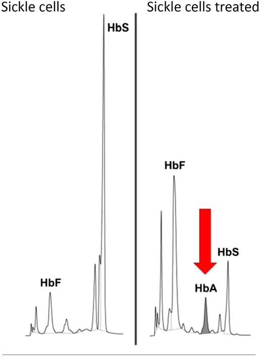 The peak of healthy hemoglobin A (HbA) in gene-edited human erythroid cells is the evidence of its functional restoration from the mutated β-globin S allele. HbS, sickle cell hemoglobin; HbF, fetal hemoglobin. Adapted from Figure 5B in the article by Hoban et al that begins on page 2597.