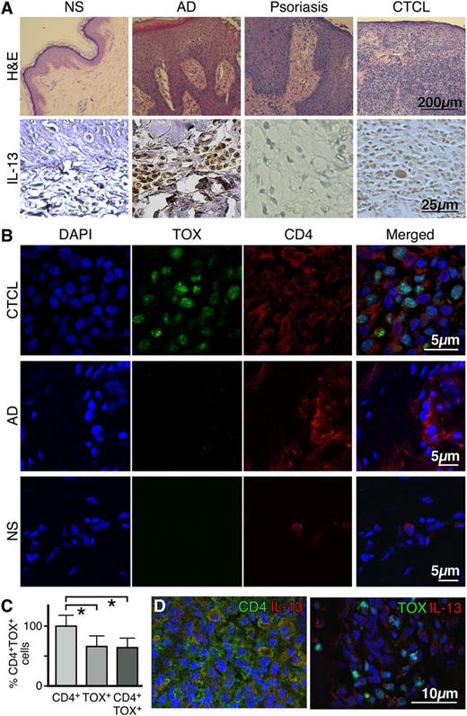 Figure 1. IL-13 is expressed by tumor cells in the skin lesions of CTCL patients. (A, upper panel) Representative hematoxylin and eosin stains of normal skin (NS), atopic dermatitis (AD), psoriasis, and CTCL skin (original magnification ×100). (A, lower panel) Immunohistochemical staining for IL-13 expression in skin biopsies from NS (n = 3), AD (n = 5), psoriasis (n = 5), or CTCL (n = 17) (original magnification ×400). (B) Double-color immunofluorescence labeling of frozen skin samples from NS (n = 3), AD (n = 3), and CTCL (n = 7) biopsies stained with antibodies to CD4 (surface staining) and TOX (nuclear staining). A representative example is shown (original magnification ×1000). (C) Proportion of CD4+ and TOX+ cells in the skin of CTCL patients. Error bars are mean ± standard deviation (SD) (n = 7). Statistics were derived by Student t test. (D) Representative example of double-color immunofluorescence staining for CD4 and IL-13 (upper panel) or TOX and IL-13 (lower panel) (original magnification ×400). Skin samples from 7 CTCL patients were analyzed giving similar results. 4,6 diamidino-2-phenylindole stains nuclei.