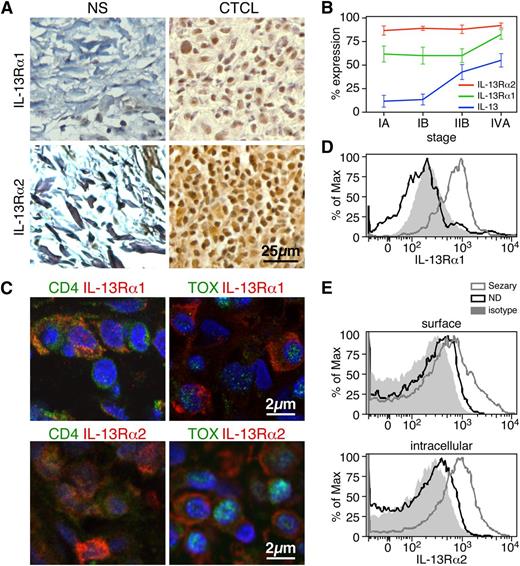 Figure 2. IL-13 receptors are expressed by tumor cells in the skin lesions of CTCL patients and in the peripheral blood CD4+ T cells of Sézary patients. (A) Expression by immunohistochemistry of IL-13Rα1 (upper panel) and IL-13Rα2 (lower panel) in biopsies from CTCL and normal skin (original magnification ×400). Representative examples are shown (n = 17 CTCL, n = 3 NS). (B) The percentages of IL-13+, IL-13Rα1+, and IL-13Rα2+ cells in CTCL skin biopsies at different disease stages are shown. Error bars are mean ± SD. (C) Representative examples of IL-13Rα1 or IL-13Rα2 costaining with CD4 or TOX by immunofluorescence of frozen CTCL skin biopsies (original magnification ×1000, n = 7). Flow cytometry expression of IL-13Rα1 (D) or IL-13Rα2 (E) in CD4+ T cells from the peripheral blood of SS patients. Representative examples out of 5 SS patients tested.