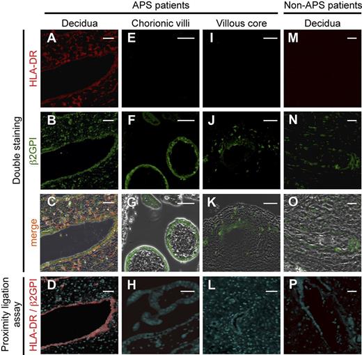 Figure 6. β2GPI is complexed with HLA-DR in endothelial cells of vessels in uterine decidual tissues obtained from APS patients. (A-C, E-G, I-K, M-O) β2GPI and HLA-DR are coexpressed in endothelial cells of vessels in uterine decidual tissues of APS patients, but not patients without APS. Tissue sections of (A-D) uterine decidua, (E-H) chorionic villi, and (I-L) villous core from APS patients and (M-P) decidua from APS-free patients were costained with anti-HLA-DR Ab (red, A, E, I, M) and anti-β2GPI Ab (green, B, F J, N). The images were merged to show colocalization of β2GPI and HLA-DR (C, G, K, O). PLA signals (red) between HLA-DR and β2GPI were analyzed in tissues of APS patients and those without APS (D, H, L, P). Scale bars, 50 μm. Data are representative of 3 independent experiments.