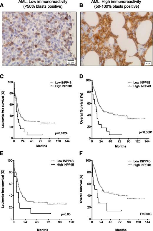 Figure 2. High INPP4B expression correlates with poor clinical outcome in AML. BM trephine sections from patients with AML (n = 205) undergoing intensive induction chemotherapy. In normal BM, only rare cells expressed INPP4B, such as megakaryocytes and occasional lymphocytes. In AML, representative cases displaying (A) low INPP4B expression (<50% blast immunoreactivity) or (B) high INPP4B expression (50% to 100% blast immunoreactivity) are shown. Kaplan-Meier survival analysis of patients with AML who received chemotherapy showed that patients with high INPP4B had significantly reduced (C) LFS and (D) OS outcomes compared with patients with low INPP4B. Worse AML (E) LFS and (F) OS outcomes were also evident for patients with intermediate cytogenetic risk.
