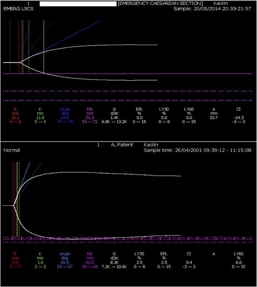 Figure 1. TEG trace 40 minutes into surgery, showing severely prolonged R and K times and reduced α angle and maximum amplitude (MA). A normal TEG trace is given for comparison (lower trace).