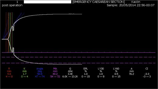 Figure 3. TEG trace following MHP 3 (2 cryoprecipitate, 3 FFP, 1 platelet, red cells), showing near complete correction of coagulopathy.