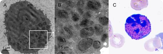 A 41-year-old man presented with epistaxis for 1 day and was found to have leukocytosis (23 200/µL) with 38% blasts, anemia (9.3 g/dL), and thrombocytopenia (7000/µL). Bone marrow aspiration and biopsy showed sheets of blasts comprising 90% of the overall cellularity. Flow cytometry and immunohistochemical stains demonstrated a population of cells that expressed CD13+, CD33+, CD34 partial+, CD45 partial+, CD117+, myeloperoxidase+, and HLA-DR+. Monosomy 7 and FMS-like tyrosine kinase 3–internal tandem duplication were detected. Acute myeloid leukemia with myelodysplastic syndrome (MDS)–related features was diagnosed based on an MDS-related cytogenetic abnormality (monosomy 7). / Peripheral smears revealed dysplastic features of eosinophils. Cytoplasmic granules of eosinophils imaged on transmission electron microscopy (TEM) revealed a high degree of heterogeneity in size with totally shattered electron-rich cores (panels A-B). This finding on TEM is a different morphologic feature from that shown in piecemeal degranulation recognized in eosinophils during inflammatory responses. Karyorrhexis is a fragmentation of the nucleus, listed as a dysplastic feature in the erythroid lineage (dyserythropoiesis) in the World Health Organization classification, but the smear results from this patient revealed a rare finding of karyorrhexis of eosinophils (dysgranulopoiesis, panel C).