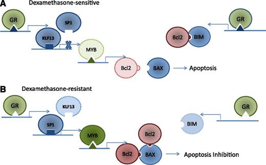 GR-mediated induction of apoptosis in dexamethasone-sensitive ALL. (A) The GR receptor binds to a novel GR promoter of KLF13, activating KLF13 binding to MYB promoter and displacing the MYB activator SP1 (left). KLF13 deactivates MYB expression, decreasing the expression of Bcl2 and allowing BAX to trigger apoptosis. Concurrently, GR also binds a GR promoter in the BIM intronic region (right), increasing BIM expression. BIM binds existing Bcl2, preventing BAX binding and resulting in BAX-mediated apoptosis. (B) Both the GR promoter in KLF13 and the intronic BIM GR promoter are absent in patient-derived leukemia cells resistant to dexamethasone, allowing Bcl2 binding to BAX, resulting in apoptosis inhibition.