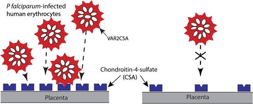 Schematic representation of the adhesion of P falciparum-infected erythrocytes to blood capillaries in the human placenta. A variant of PfEMP1 encoded by the var2CSA gene, expressed on the surface of infected erythrocytes, binds to CSA, a component of the proteoglycan matrix on placenta. PfEMP1 is presented in knob-like protrusions, and sequestration of infected erythrocytes in the placenta is believed to result in maternal malaria, a severe syndrome associated with low birth weight, prematurity, and chronic intervillositis. Higher receptor density (CSA) leads to greater binding and cooperativity as measured by functionalized membranes model system in vitro.1