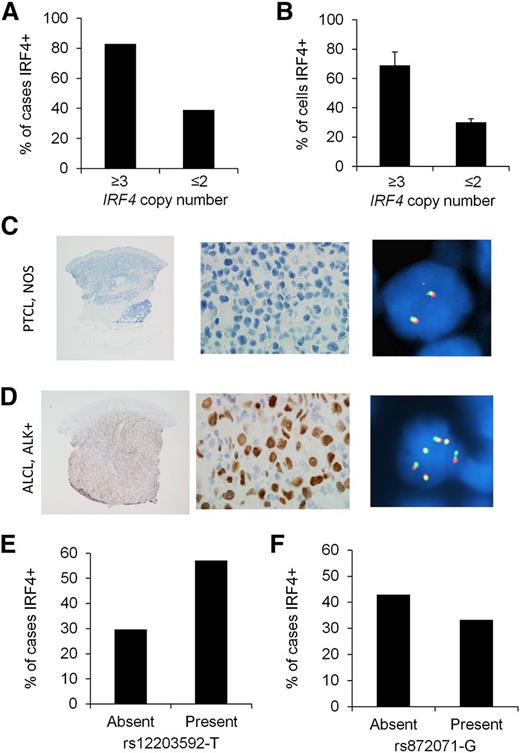 Figure 2. IRF4 protein expression is associated with IRF4 CNAs in PTCLs. (A) Eighty-three percent of PTCLs with extra copies of IRF4 were IRF4 protein positive, compared with 39% of cases without extra copies (P = .0002). (B) PTCLs with extra copies of IRF4 had a higher mean percentage of tumor cells with IRF4 staining than those without extra copies (P = .0001). (C) PTCL, not otherwise specified (NOS), involving the skin. IHC shows no evidence of IRF4 expression (left panel, ×20; middle panel, ×400). IRF4 FISH using a break-apart probe shows a normal signal pattern (2 intact red/green fusion signals; right panel, ×600). (D) ALCL, anaplastic lymphoma kinase (ALK) positive, involving the skin. IHC shows nuclear IRF4 expression (left panel, ×20; middle panel, ×400). IRF4 FISH shows multiple intact copies of the IRF4 gene (6 fusion signals in cell shown; right panel, ×600). (E) The germ-line SNP rs12203592-T was significantly associated with IRF4 positivity in PTCLs (P = .03). (F) The germ-line SNP rs872071 was not significantly associated with IRF4 positivity (P = .39).