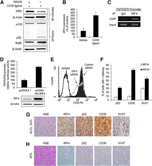 Figure 5. Reciprocal regulation of IRF4 and CD30 in PTCL cells. (A) CD30 ligand (100 ng/mL) activated the NF-κB pathway in Karpas 299 cells, as evidence by depletion of IκBα, increased RelB expression (156% of control), and cleavage of p100 into p52. Karpas 299 and the other cell lines studied do not express endogenous CD30 ligand (supplemental Figure 6B). (B) Stimulation with CD30 ligand for 24 hours increased IRF4 gene expression (P = .033). (C) IRF4 ChIP demonstrated interaction of IRF4 with the TNFRSF8 promoter in Karpas 299 cells (see also supplemental Figure 6A). (D) Overexpression of IRF4 increased TNFRSF8 promoter activity (luciferase assay, P = .0029). (E) Knockdown of IRF4 decreased surface CD30 protein expression, as detected by flow cytometry. (F) IRF4-positive PTCLs had significantly higher percentages of cells staining for p52 (nuclear; P < .0001), CD30 (P < .0001), and KI-67 (P < .0001). (G) ALCL, ALK negative. IHC showed strong nuclear expression of IRF4 and p52, uniform staining for CD30, and a high proliferative rate by KI-67 (all images, ×400). (H) Angioimmunoblastic T-cell lymphoma (AITL). The tumor cells were negative for IRF4, p52, and CD30 and showed a low proliferative rate by KI-67 (×400).
