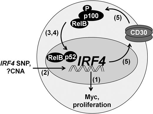 Figure 6. Positive feedback loop regulating IRF4 expression in PTCL. IRF4 is transcriptionally regulated by the alternative NF-κB pathway (RelB/p52), augmented in some cases by the intronic IRF4 SNP rs12203592-T. IRF4 CNAs are associated with IRF4 protein expression, but their contribution to IRF4 transcription is not known. IRF4 drives Myc expression and tumor proliferation. In addition, IRF4 increases CD30 expression, leading to activation of NF-κB and perpetuation of IRF4 expression. Numbers in parentheses indicate figure numbers corresponding to relevant experiments.