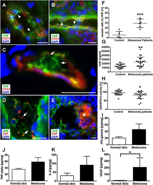Figure 2. Local inhibition of ADAMTS13 promotes VWF fiber formation in microvessels obtained from human melanoma patients. Cryosections of human malignant melanoma tissue, healthy control skin, and basal cell carcinoma were analyzed by immunofluorescence stainings for VWF and CD31 (A-C) or thrombospondin (TSP) (D-E). Nuclei were stained with DAPI. Analysis of healthy skin (A) and human basal cell carcinoma (B) as control demonstrate storage of VWF in the vessel wall (arrowheads). ULVWF fibers are detected in the lumen of the microvessels, correlating to reduced VWF within the vessel wall indicative of EC activation (C, arrows). These ULVWF fibers bind platelets (D, arrows) and are associated with microthrombi formation in distinct microvessels (E, asterisk; n = 5 to 6; scale bars = 20 µm). Quantification showed significantly increased numbers of vessels with luminal VWF fibers in tumor vasculature compared with healthy skin (F). Systemic VWF level in blood samples of malignant melanoma patients was increased compared with healthy control (G). By contrast, only a slight reduction of ADAMTS13 activity was observed (H). Tumor-derived cytokines and growth factors were measured in healthy control skin and tumor of human malignant melanoma by bio-plex. Cytokine levels of IFN-γ (I), TNF-α (J), and IL-6 (K) were increased in tumor samples compared with control skin. The concentration of VEGF-A was significantly increased within melanoma compared with control (L). Results of 9 different melanoma patients are shown (*P < .05, **P < .005, ***P < .001). Bars indicate the mean ± SD.