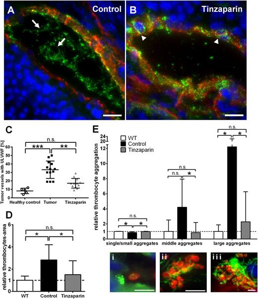 Figure 5. Blocking VEGF-A using tinzaparin reduces VWF fiber formation in tumor microvasculature. Immunofluorescence stainings for VWF (green) and anti-CD31 (red) in cryosections of ret transgenic tumors were performed. Nuclei were stained with DAPI. Tumor microvessels of control mice showed formation of ULVWF fibers in the vessel lumen (A, arrows). By contrast, microvessels of tinzaparin-treated mice showed almost no ULVWF fiber formation and a punctual pattern of VWF within the vessel wall (B, arrowheads), indicative of reduced endothelial cell activation. Representative pictures of tumor microvessels are shown (n = 10 animals of 2 independent experiments; scale bars = 20 µm). Tinzaparin treatment correlated with a significant reduction of vessels with intraluminal VWF fibers (C). Tumor vessels were analyzed for platelet aggregation using VWF (green) and GPIb (red) staining. Quantification showed a significant increase in platelet-covered area in the lumen of tumor vessels compared with control. This effect was abolished by treatment with tinzaparin (D-E). Panel Ei shows a single platelet in the lumen of a tumor blood vessel. In addition, the treatment of ret transgenic mice with tinzaparin (gray) reduced the appearance of middle (ii) and big aggregates (iii) to healthy control skin levels (white) compared with vehicle-treated control tumors (black). Plot shows mean ± SD (n = 5-10; *P < .05; **P < .005; ***P < .001; scale bars = 5 µm).