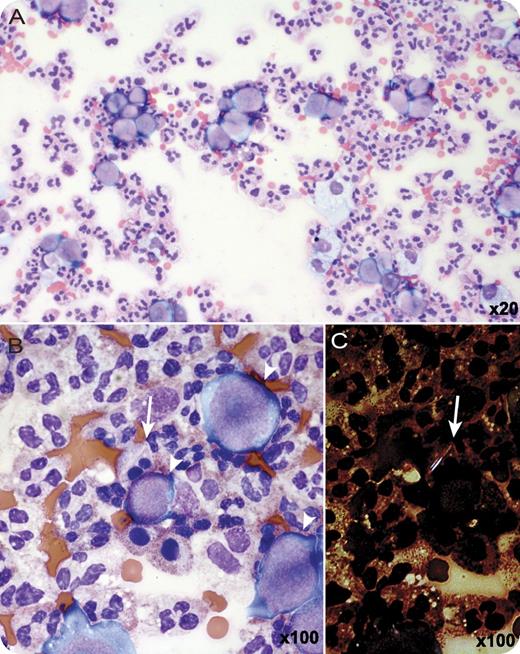 A 45-year-old man with a history of gout for 6 years was maintained with allopurinol. One and a half years prior to admission, he was diagnosed with diffuse large B-cell lymphoma (germinal center type) with primary orbital presentation. He failed combination chemotherapy with rituximab, cyclophosphamide, hydroxydaunomycin, oncovin, and prednisone because of continued disease progression and was switched to an alternative combination chemotherapy regimen with rituximab, ifosfamide, carboplatin, and etoposide, which provoked a polyarticular gout flare. His lymphoma was stable until he was admitted for a swollen left knee. At this time, he was noted to have widespread involvement of retroperitoneal and intraperitoneal soft tissue, psoas muscle, and the right kidney. / Microscopic examination of the joint fluid from his left knee showed a white blood cell count of 5005 and both large lymphoma cells and neutrophils (panel A), some of which showed intracellular negatively birefringent crystals (panel B, arrow shows neutrophil with intracellular negatively birefringent crystal, and arrowheads point to large lymphoma cells; panel C, arrow shows intracellular negatively birefringent crystal) consistent with monosodium urate (gout). He responded to gout treatment, but died of lymphoma 1.5 months later. Lymphomatous involvement of the joint is rare and has only been reported 13 times. Our case was diagnosed because it coincided with a gout flare related to treatment of his lymphoma necessitating arthrocentesis.