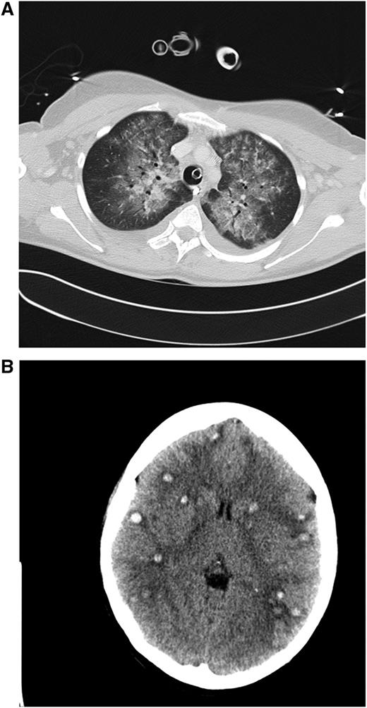 Figure 1. Clinical case 1. A 42-year-old woman presented to her general practitioner with general weakness and tooth pain. Laboratory assessment showed a WBC count of 80 000/µL, hemoglobin of 6.4 mg/dL, and platelet count of 21 000/µL, which led her physician to make an immediate referral to the local hospital, where a differential blood count revealed 56% myeloid blasts. By that time, the patient was in stable clinical condition with a minimally elevated C-reactive protein of 20 mg/L. She was put on 4 g hydroxyurea (HU) and planned for transferal to our hospital the next morning. During the night, she developed dyspnea requiring oxygen supply. We diagnosed an AML M4eo with inv(16) and started induction treatment with cytarabine plus daunorubicin (7 + 3) at a WBC count of 70 000/µL. Immediate leukapheresis was not possible because of the progressive dyspnea and the increasingly deranged coagulation status. By the next day, the WBC count had gone down to 19 000/µL, but the patient developed respiratory failure requiring mechanical ventilation. The computed tomography (CT) scan result was highly suggestive for leukostasis of the lungs (A), and cranial CT showed multiple focal supratentorial hemorrhages (B). During the next few days, respiratory indices improved, and the patient could be extubated. Early bone marrow response assessment showed a good response with leukemia-free hypoplastic marrow, and after regeneration of peripheral counts, a complete remission (CR) was diagnosed. The patient has currently completed consolidation chemotherapy and is in ongoing CR. The remarkable aspects of this case are (1) the fact that leukostasis developed rapidly even at a WBC count below 100 000/µL, possibly because of the monocytic nature of blasts11; (2) cytarabine alone led to a profound and rapid WBC reduction; and (3) the patient recovered from mechanical ventilation because the underlying leukostasis could be treated successfully. (A) Contrast-enhanced CT image (lung window) through the upper fields of the lungs demonstrates parenchymal infiltrates as well as diffuse ground-glass opacities suggestive for leukostasis and myeloblast infiltration. There is sparing of the lung periphery. Note also bilateral pleural effusions. Respiratory failure required mechanical ventilation support as indicated by the endotracheal tube. A central venous catheter in the right brachiocephalic vein and nasogastric tube in the esophagus can be seen. (B) Horizontal plane of native cranial CT scan demonstrating multiple hyperdense lesions in both brain hemispheres indicating hemorrhagic lesions. Accompanying cerebral edema is characterized by loss of gray-white matter differentiation, compression of lateral ventricles, and effacement of sulcal spaces.