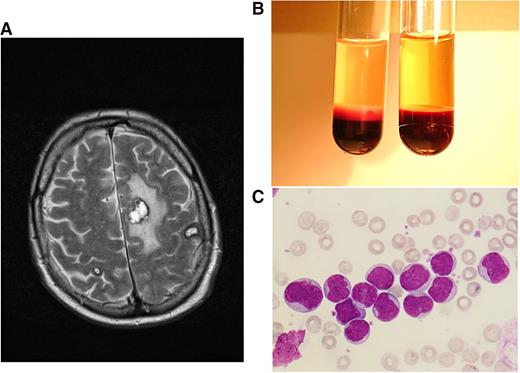 Figure 2. Clinical case 2. A 68-year-old man sought medical help at the emergency unit of his local hospital because of weakness, bone pain, and night sweats over several weeks. He was admitted because of HL of ∼170 000/µL, anemia, and thrombocytopenia. After the diagnosis of AML M4 was made, HU and cytarabine were started, and the patient was transferred to our hospital, presenting with a WBC count 70 000/µL and central neurologic deficits with speech impairment. A magnetic resonance imaging (MRI) scan showed several meningeal lesions, but the cerebrospinal fluid cell count was normal, and infection parameters were negative. In order to avoid cerebrospinal fluid contamination with leukemic blasts, lumbar puncture was postponed until peripheral blast clearance. We continued cytarabine induction and added daunorubicin for 3 days. WBC counts declined rapidly after initiation of cytarabine; the patient’s ability to speak improved gradually, and a control MRI 7 days after admission showed multiple hemorrhagic lesions, most pronounced in the hemispheres, with no signs of extramedullary leukemic lesions or meningeosis (A). In the consecutive aplasia, our patient developed Escherichia coli septicemia and Systemic Inflammatory Response Syndrome (SIRS) requiring epinephrin support. Early response assessment revealed persisting AML in the bone marrow. After having recovered from the sepsis, he developed a rapid relapse with WBCs rising up to 150 000/µL within 1 week (B,C). Intermediate-dose cytarabine plus mitoxantrone was administered as salvage treatment. In the consecutive aplasia, our patient received allogeneic stem cell transplantation from a matched unrelated donor after reduced-intensity conditioning with busulfan and fludarabin, leading to a rapid engraftment and the establishment of a stable donor chimerism. This case is highly suggestive for cerebral manifestations of leukostasis, possibly associated with extravasation and extramedullary infiltration of myeloid blasts. Primary refractory disease could be overcome by higher-dose cytarabine salvage treatment, and sustained response of this high-risk disease could be achieved by allogeneic stem cell transplantation. (A) T2-weighted axial plane of cranial MRI scan showing multiple brain hemorrhages (in correlation with other sequences) at the stage of extracellular methemoglobin with marked perifocal edema. (B) Peripheral-blood sample from patient 2 at hyperleukocytotic relapse (containing EDTA for anticoagulation). Cell settlement revealed a pronounced buffy coat containing excessive numbers of leukemic cells (left tube) as opposed to blood from an age-matched healthy man (right tube). (C) Peripheral-blood smear of patient 2 at hyperleukocytotic relapse (May-Grünwald and Giemsa stain, ×400) showing numerous myeloid blasts with wide cytoplasm and large euchromatin-containing nuclei with 1 or more nucleoli.