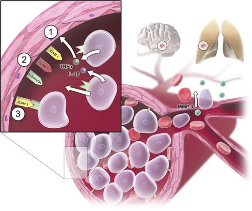 Figure 3. Pathogenetic mechanisms in leukostasis. Sludging of circulating myeloblasts causes mechanical obstruction of small vessels and consecutive malperfusion in the microvasculature (eg, in organs such as brain and lungs). Apart from the mechanical obstruction, myeloblasts adhere to the endothelium by inducing endothelial cell adhesion receptor expression including E-selectin, P-selectin, intracellular adhesion molecule-1 (ICAM-1), and vascular cell adhesion molecule-1 (VCAM-1). Myeloblasts can promote their own adhesion to unactivated vascular endothelium by secreting tumor necrosis factor-α (TNF-α), interleukin-1β (IL-1β), or additional stimulating factors (sequence of events represented by steps 1 to 3).30 Additional changes after cytokine-driven endothelial cell activation can be a loss of vascular integrity and modification of endothelial phenotype from antithrombotic to prothrombotic phenotype.35,36 Endothelial disintegration allows myeloblast migration and blood extravasation and microhemorrhages. Tissue invasion of myeloblasts is mediated by metalloproteinases (MMPs; particularly MMP-9), which are expressed on the cellular surface and secreted into the extracellular matrix.31,33,34,37