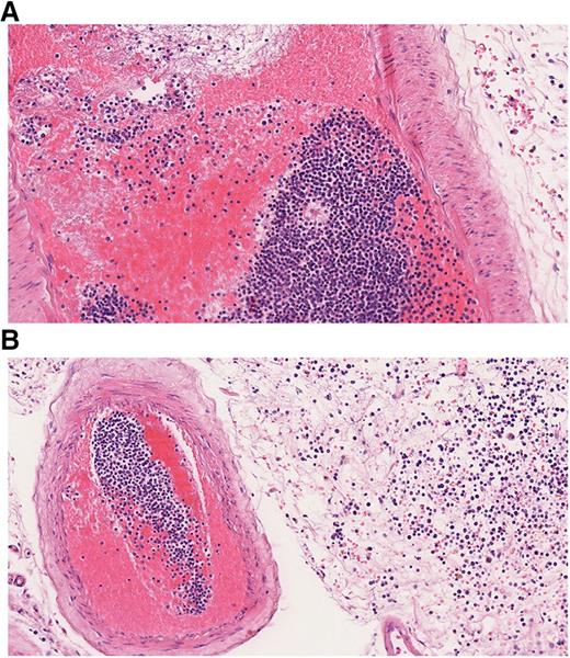 Figure 4. Histopathological finding in leukostasis. Specimen from the leptomeninges of an AML patient postmortem stained with hematoxylin and eosin (×200). (A) Large numbers of immature WBCs in a leptomeningeal capillary artery presumably leading to reduced blood flow and thrombus formation with strands of fibrin, red blood cells (RBCs), and WBCs. (B) Numerous myeloid blasts and some RBCs are present in the extravascular space, infiltrating the leptomeningeal tissue.