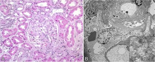 Figure 2. Kidney biopsy from subject III-12. (A) Hematoxylin and eosin–stained section showing deposits in glomerular basement membrane (original magnification ×100). (B) Electron micrograph showing amyloid deposits with 7- 10-μm fibrils (inset) consistent with amyloid.