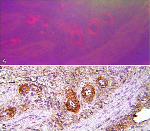 Figure 3. Serial microscopic sections of gallbladder wall from index patient (III-15). (A) Stained with Congo red and viewed by fluorescence microscopy. (B) Stained by indirect immunohistochemistry with polyclonal anti-immunoglobulin κ light-chain antiserum showing specific staining of amyloid deposits (original magnification ×100).