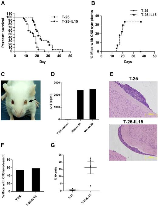 Figure 1. Constitutive expression of IL-15 in T-25 lymphoma cells increases survival of mice and is associated with clinical CNS symptoms. (A) Kaplan-Meier survival curve of 7-day-old BALB/C mice injected with either T-25-IL15 (n = 27) or T-25 cells (n = 28) (P < .0001, log-rank test). (B) Kaplan-Meier curve depicting the accumulated rate of CNS symptoms. Mice were monitored every day for clinical symptoms for CNS involvement including spin when held by tail, ataxia, and side-walk. These symptoms were present only in the T-25-IL15 group. (C) Representative picture of a T-25-IL15-injected mouse with ocular involvement. Note the opacity of the left eye (arrow) caused by accumulation of lymphoma cells in the left anterior chamber. (D) IL-15 secretion was measured by enzyme-linked immunosorbent assay in cells derived from the eyes of T-25-IL15-injected mice (n = 2). The T-25-injected mouse served as a control. (E-F) Hematoxylin and eosin staining of brain sections derived from T-25- (upper) and T-25-IL15-injected mice (lower), showing infiltration of lymphoma cells in the subarachnoid space. Histopathology analysis revealed that there was no difference in the number of mice with CNS involvement between both groups. (G) T-25-IL15-injected mice exhibited a significant increase in peripheral blood NK cells. Values presented as means ± SE (P = .01, t test).