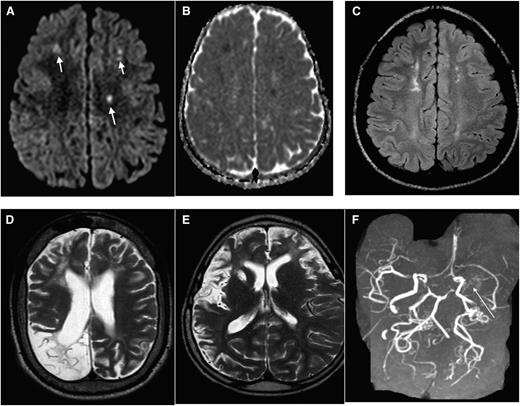 Figure 1. MRI in SCD: spectrum of abnormality in SCD as illustrated by different imaging examples. Axial DWI (A) and apparent diffusion coefficient (ADC) (B) map of the brain demonstrating multiple foci of restricted diffusion along bifrontal regions (corresponding to the short arrows in A), along the internal watershed zone most consistent with acute strokes. (C) Axial fluid attenuation inversion recovery (FLAIR) image in a different patient with SCD demonstrate areas of old (silent) infarctions in a similar internal watershed distribution. (D) Axial T2 image shows a large area of right occipital cystic encephalomalacia resulting from prior infarction. (E) Axial T2 image from another patient shows diffuse volume loss, sulcal prominence, and an old right basal ganglia infarct from sickle cell-associated vasculopathy. (F) Maximum intensity projection image from the MRA shows nonvisualization of the left MCA with multiple collateral in the left lenticulostriate distribution (long arrow), consistent with moyamoya collaterals.