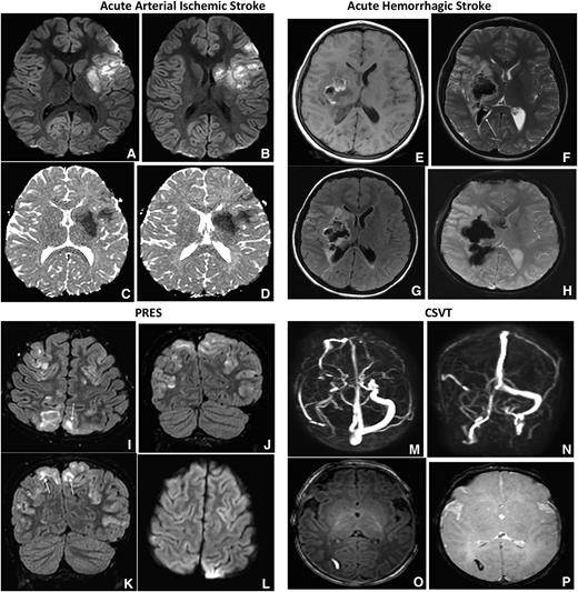 Figure 2. Acute arterial ischemic and hemorrhagic stroke, PRES and CSVT. Axial DWI and ADC (shown in A-B and C-D in each of the 4 sets of images, respectively) MRIs of the brain demonstrate increased DWI signal with corresponding decreased ADC signal, consistent with restricted diffusion along the left MCA territory most consistent with acute arterial ischemic stroke. Axial T1-weighted MRI (E), axial T2-weighted MRI (F), axial FLAIR (G), and axial GRE (H) images in patients with SCA demonstrate ill- defined mixed intensity focus within the right basal ganglia region with surrounding vasogenic edema. The lesion demonstrates T1 hyperintensity with hypointensity on axial T2 and GRE consistent with hemorrhage. Also seen is intraventricular extension of blood (F, arrow). GRE MR sequences are most sensitive for the detection of intracranial hemorrhage and may demonstrate more diffuse signal loss than the actual lesion, also known as blooming, as seen in this case. Axial FLAIR (I) and coronal FLAIR images MR (J-K) of the brain demonstrates bilateral near symmetric hyperintense signal involving the parieto-occipital lobes with superior frontal involvement, in a distribution and pattern most consistent with PRES. There is both subcortical (I, K arrows) and cortical involvement. Axial DWI (L) demonstrates no corresponding increased signal to suggest for restricted diffusion. Transverse (M) and coronal (N), maximum intensity projection images from a phase contrast MRV. There is no signal within the right transverse sinus due to thrombosis. Axial T1-weighted MRI (O) demonstrates a small well-defined hyperintense focus within the right occipital white matter with hypointensity on axial GRE (P), consistent with hemorrhagic venous infarction secondary to thrombosis.