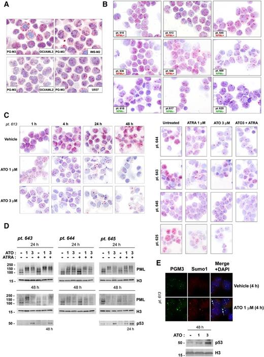 Figure 3. ATO induces PML intracellular reorganization and downregulation associated with p53 upregulation in human NPM1-mutated AML cells. PML (PG-M3) immunocytochemical staining pattern in NPM1-mutated (OCI/AML3 and IMS-M2) vs NPM1 wild-type (OCI/AML2 and U937) AML cell lines (A) and representative NPM1-mutated (n = 5, NPMc+) vs NPM1 wild-type (n = 4, NPMc−) primary AML patients cells (B). Pt. followed by number indicates patient code. (C) PML immunocytochemical staining pattern changes upon ATO/ATRA treatment in primary NPM1-mutated AML patient cells. AML cells from pt. 613 were treated either with vehicle alone (vehicle control) or different ATO concentrations (1 and 3 μM) for the time indicated, and cytospin preparations stained for PG-M3 (left). See panel B, pt. 613, for comparison with the basal PG-M3 staining pattern. AML cells from pts. 643, 644, 645, and 625 were either left untreated or treated with ATO (3 μM), ATRA (1 μM), and ATO plus ATRA for 24 hours, and cytospin preparations stained for PG-M3 (right). (A-C) APAAP technique; hematoxylin counterstaining. Images were collected using an Olympus B61 microscope and a UPlan FI ×100/1.3 NA oil objective; Camedia 4040, Dp_soft Version 3.2; and Adobe Photoshop 7.0. (D) Western blot analysis of PML protein expression upon ATO/ATRA treatment in 3 representative NPM1-mutated AML patients samples. p53 protein levels in untreated vs treated AML cells are shown for pts. 643 and 645. The same membranes were blotted for histone H3 for loading control. (E) PML (PG-M3, secondary goat anti-mouse Alexa-Fluor 488, green) and Sumo1 (Sumo1, secondary goat anti-rabbit Alexa-Fluor 568, red) immunofluorescence staining upon ATO treatment in 1 representative NPM1-mutated AML patient (upper). Nuclei are stained with DAPI (blue). White arrows indicate representative colocalization of Sumo1 and PML (yellow) in NBs. Images were collected by fluorescence microscope (Olympus, Shinjuku, Tokyo, Japan) using a ×100/1.3 NA oil objective and processed with CellSens Digital Imaging Software (Olympus) and Adobe Photoshop 7.0. Western blot analysis for p53 upon ATO treatment on AML cells from the same patient (pt. 613, lower). Histone H3 was used as loading control.