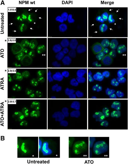 Figure 5. ATO/ATRA induce NPM1 wild-type protein relocalization in the nucleus in NPM1-mutated OCI/AML3 cells. (A-B) Immunofluorescence staining for NPM1 wild-type protein using a specific mouse monoclonal antibody (NPMwt) (secondary goat anti-mouse Alexa-Fluor 488, green) of cytospin preparations from NPM1-mutated AML cell line OCI/AML3, untreated vs treated with ATO 3 μM, ATRA 1 μM, or ATO/ATRA combination for 24 hours. Nuclei are stained with DAPI (blue). Images were collected at fluorescence microscope (Olympus, Shinjuku, Tokyo, Japan) using a ×100/1.3 NA oil objective and processed with CellSens Digital Imaging Software (Olympus) and Adobe Photoshop 7.0. White arrows in panel A point to representative NPM1 wild-type cytoplasmic positivity. White asterisk(s) in panel A indicate representative cells reproduced in panel B for details. Number of nucleoli/cell (means ± SD on 50 cells) is shown in the inset in panel A. Black asterisks indicate statistical significance.