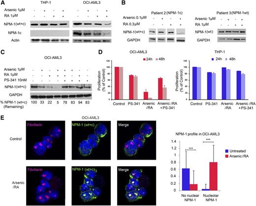 Figure 3. RA and arsenic induce proteasomal degradation of mutant NPM1 and restore NPM1 nucleolar localization. (A) Western blot analysis for NPM1 recognizing both WT and mutated NPM1 (WT + c), mutated NPM1 (NPM1c), actin in THP-1, and OCI-AML3 cells treated with arsenic (1 μM), RA (1 μM), or a combination of both for 48 hours as indicated. A representative of 3 independent experiments is shown. (B) Western blot analysis for NPM1 (WT + c) and glyceraldehyde-3-phosphate dehydrogenase (GAPDH) in primary leukemic cells derived from AML patients treated with arsenic (0.1 or 1 μM), RA (0.3 or 1 μM), or a combination of both for 48 hours as indicated. (C) Western blot analysis for NPM1 (WT + c) and GAPDH in OCI-AML3 cells treated with arsenic (1 μM), RA (1 μM), PS-341 (10 nM), either alone, or in combination for 48 hours as indicated. Percentages indicate the amount of remaining NPM1 (WT + c) after normalization to GAPDH. (D) Cell count with trypan blue staining (percent of control) of OCI-AML3 and THP-1 cells treated with arsenic (1 μM), RA (1 μM), PS-341 (10 nM), either alone, or in combination for up to 48 hours. Cell growth (percent of control) was assayed in triplicate wells. The results depict one representative experiment among 3 independent ones. (E) Confocal microscopy analysis of nucleolar NPM1 localization in OCI-AML3 or THP-1 cells after treatment with RA/arsenic for 48 hours. NPM1 was stained with an antibody recognizing NPM1 (WT + c) (green), nucleoli were stained with anti-Fibrillarin (red), and nuclei were stained with 4,6 diamidino-2-phenylindole (blue). Images represent Z sections. Graphs show quantification of nucleolar NPM1 as averages of one Z section/cell from 30 different cells of 3 independent experiments. Significant P values are indicated by asterisks.